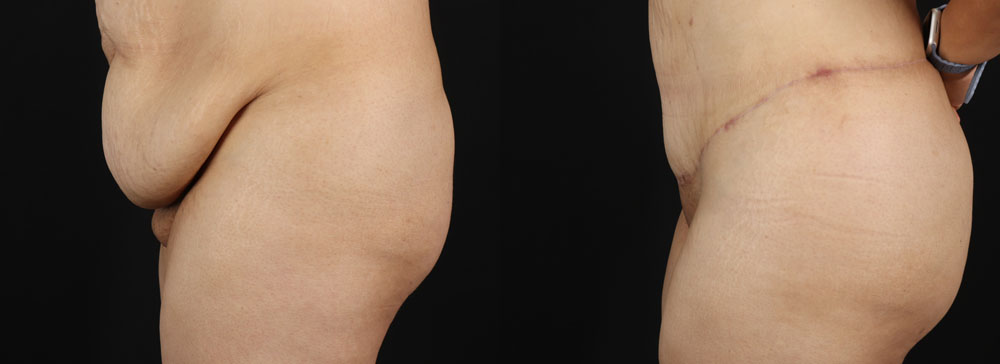 Post Bariatric Surgery (Massive Weight Loss) case #256488