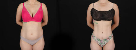 Tummy Tuck case #256517