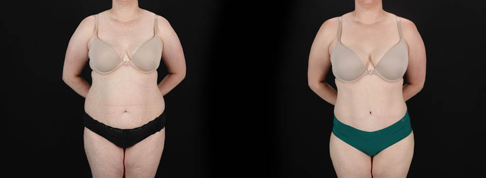 Tummy Tuck case #256538