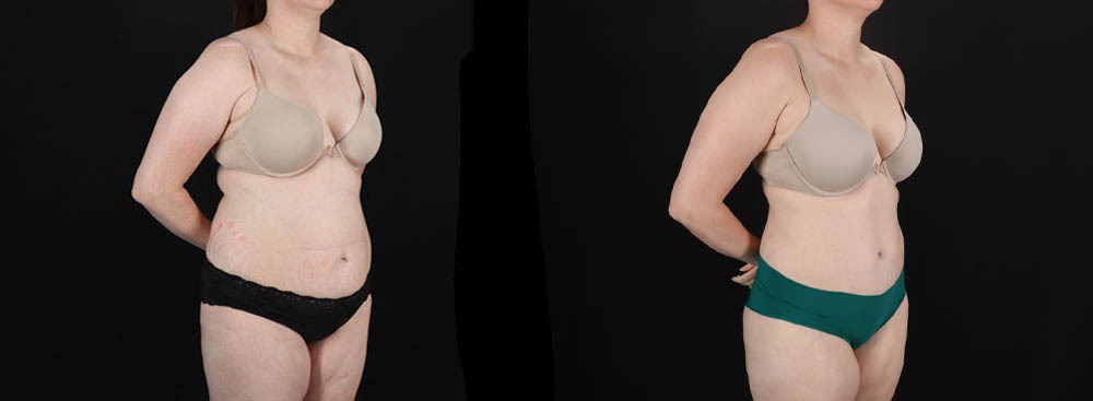 Tummy Tuck case #256538