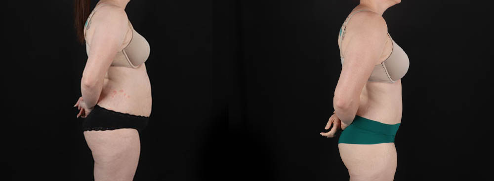 Tummy Tuck case #256538