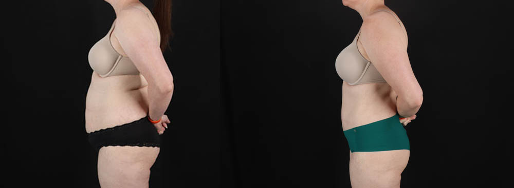 Tummy Tuck case #256538