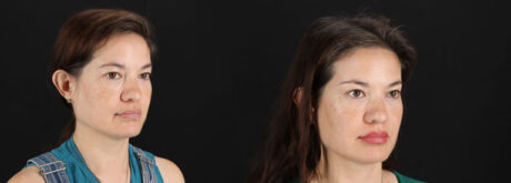 Skin Pen Microneedling case #256549