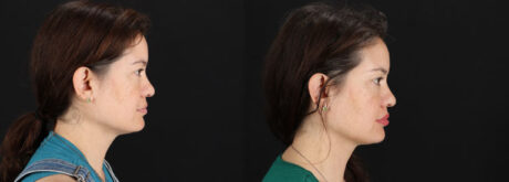 Skin Pen Microneedling case #256549