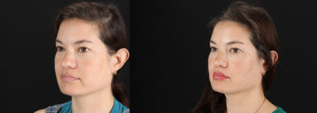 Skin Pen Microneedling case #256549