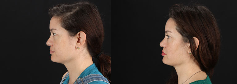 Skin Pen Microneedling case #256549