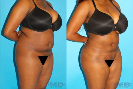 Brazilian Butt Lift case #256576