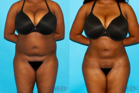 Brazilian Butt Lift case #256576