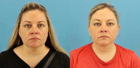 Fraxel Laser case #256597