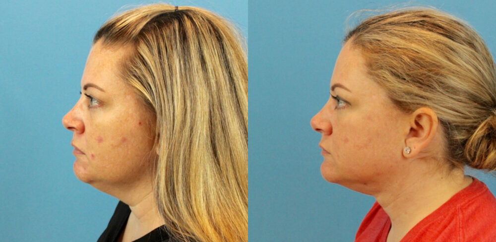 Fraxel Laser case #256597