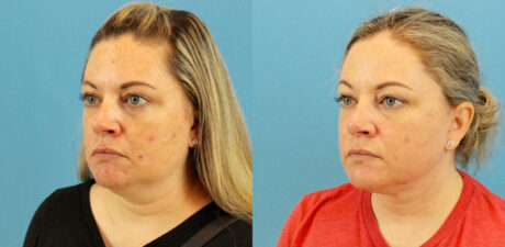 Fraxel Laser case #256597