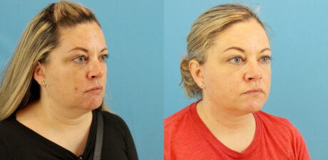 Fraxel Laser case #256597