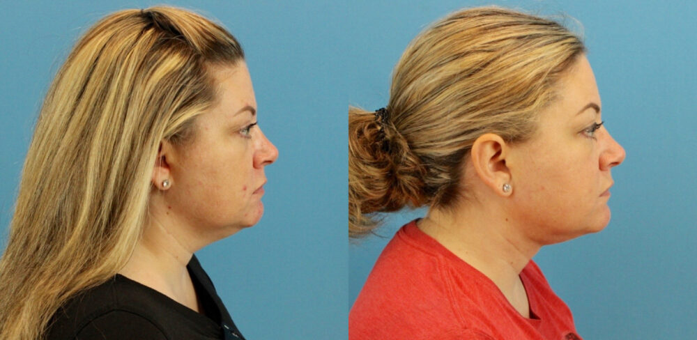 Fraxel Laser case #256597