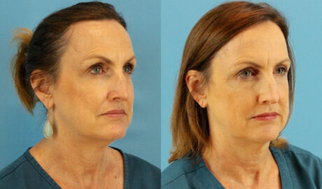 Fraxel Laser case #256598