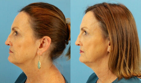 Fraxel Laser case #256598