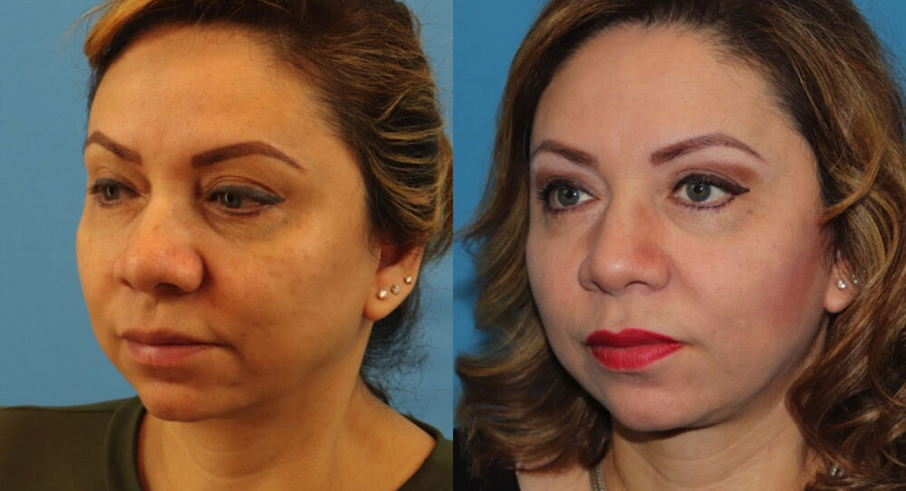 Co2 Laser case #256599