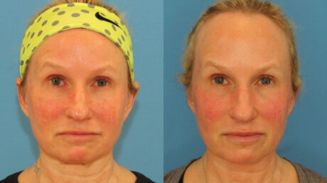 Fraxel Laser case #256600