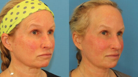 Fraxel Laser case #256600