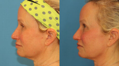 Fraxel Laser case #256600