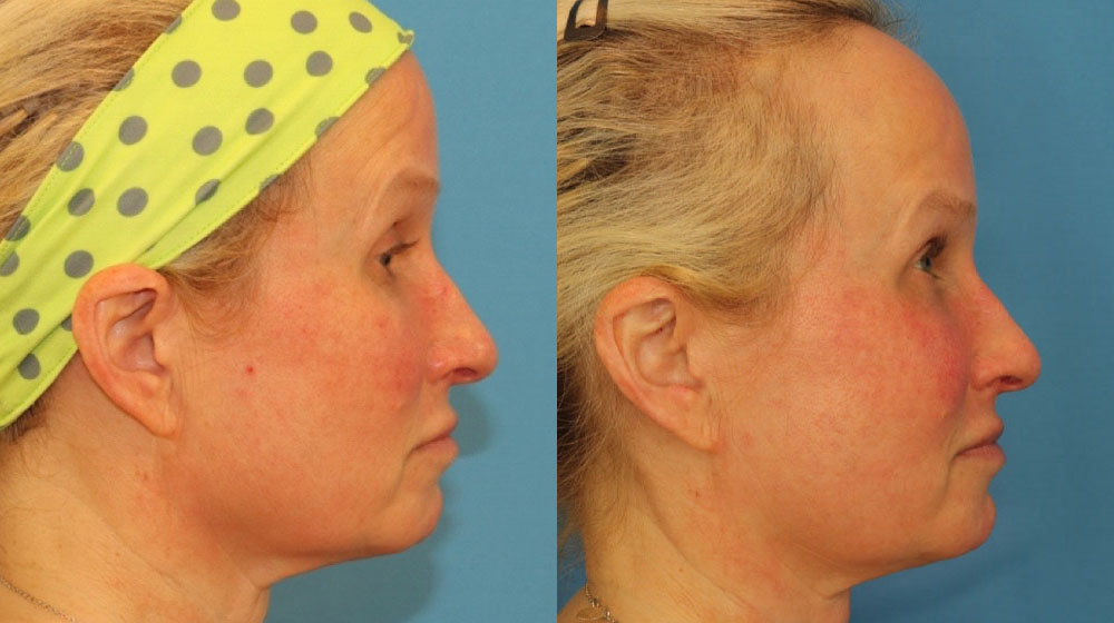 Fraxel Laser case #256600