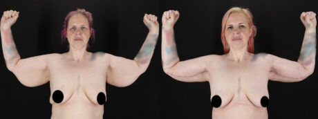 Arm Lift case #256569