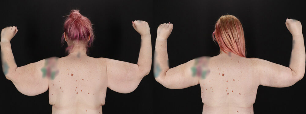 Arm Lift case #256569