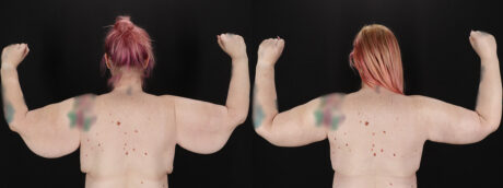 Arm Lift case #256569