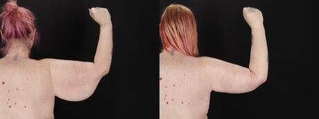 Arm Lift case #256569