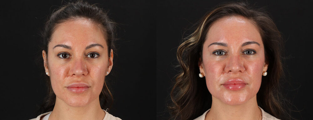 Co2 Laser case #256594