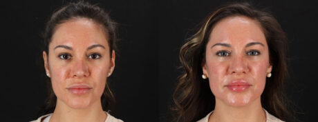 Co2 Laser case #256594