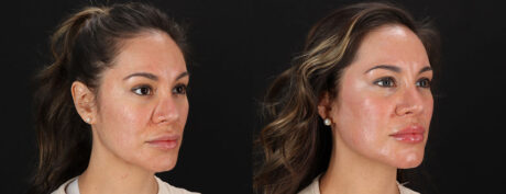 Co2 Laser case #256594