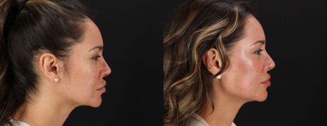 Co2 Laser case #256594