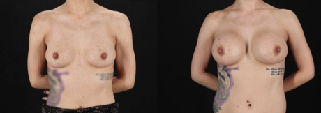 Breast Augmentation case #6444