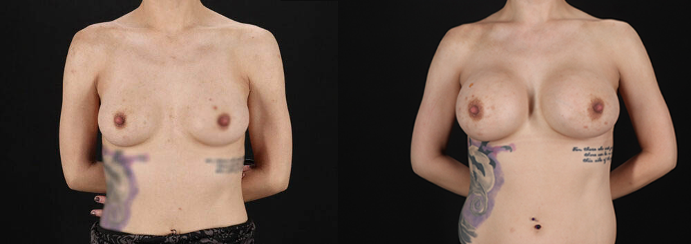 Breast Augmentation case #6444