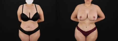 Tummy Tuck case #7618