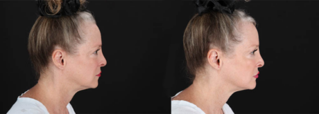 Botox® & Other Neuromodulators case #257429