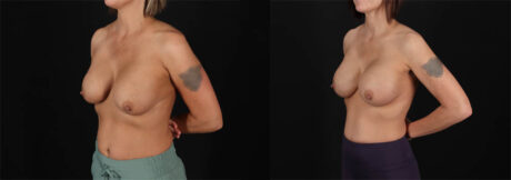 Revision Breast Surgery case #257422