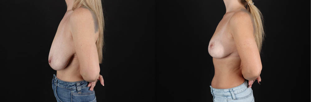 Breast Lift case #7826