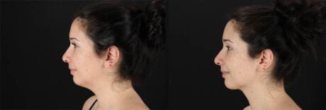 Submental Liposuction case #257416