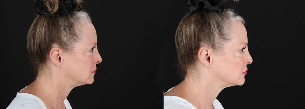 Botox® & Other Neuromodulators case #257429