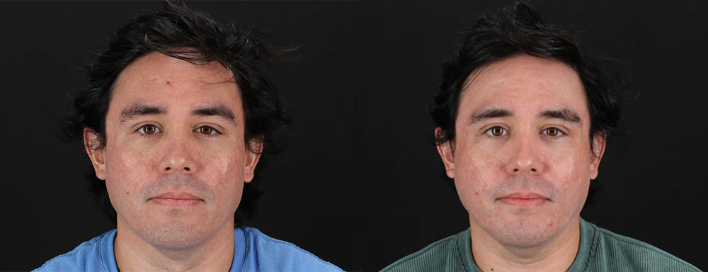 Co2 Laser case #256595