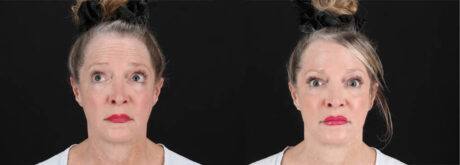 Botox® & Other Neuromodulators case #257429