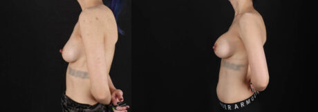 Breast Augmentation case #6444