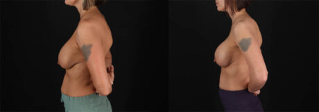 Revision Breast Surgery case #257422