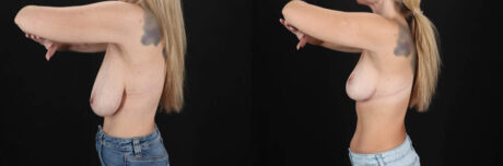 Breast Lift case #7826