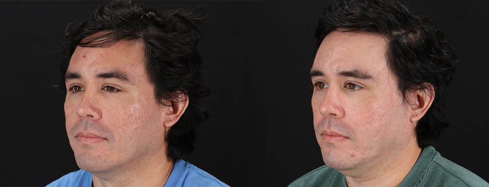 Co2 Laser case #256595