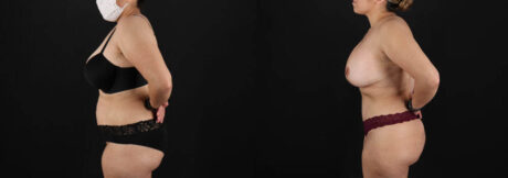 Tummy Tuck case #7618