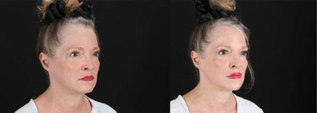 Botox® & Other Neuromodulators case #257429