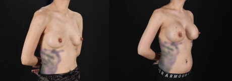 Breast Augmentation case #6444