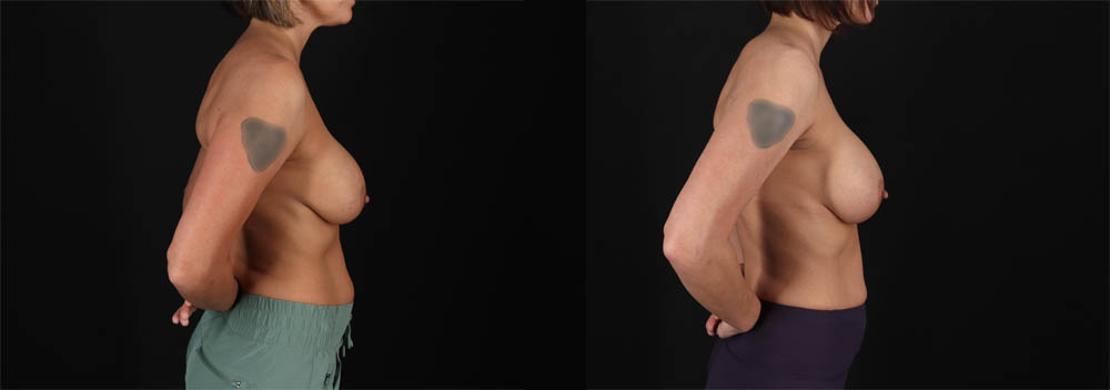 Revision Breast Surgery case #257422